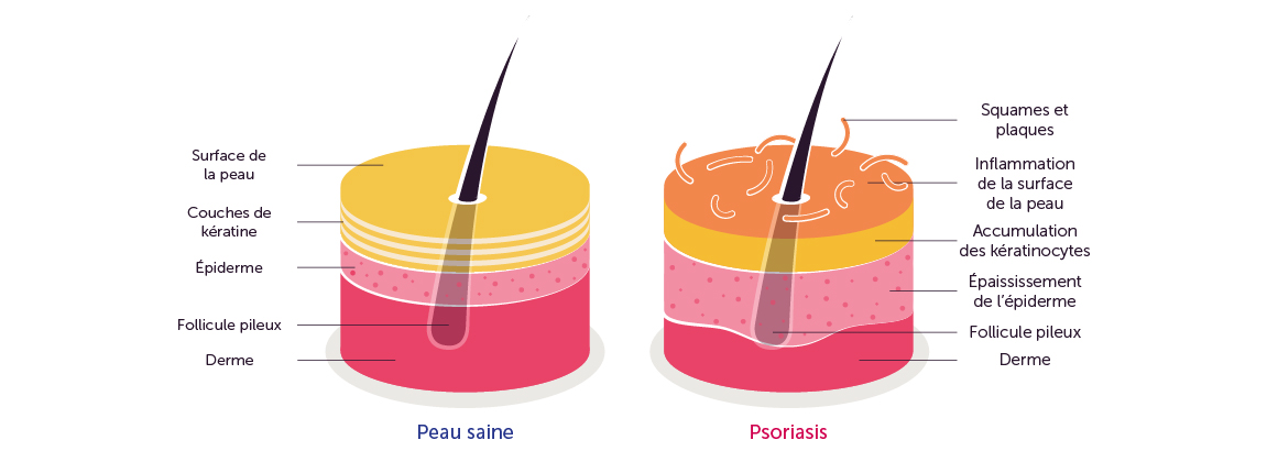 Structure de la peau atteintes du psoriasis
