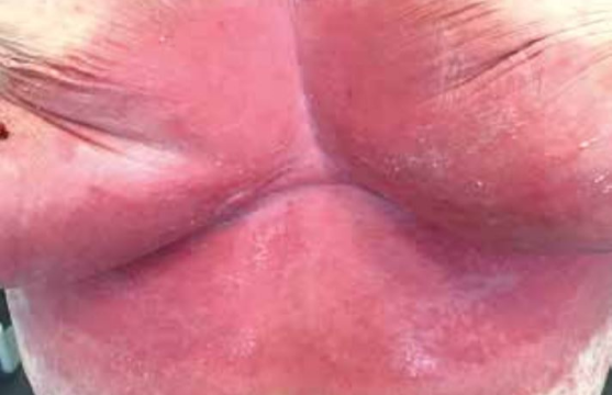 Le psoriasis inverse touche les plis de la peau comme les aisselles, l’aine ou sous les seins.