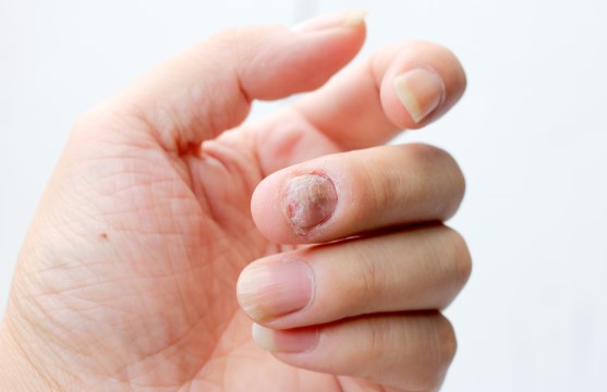 psoriasis de l'ongle aussi appelé psoriasis unguéal. 