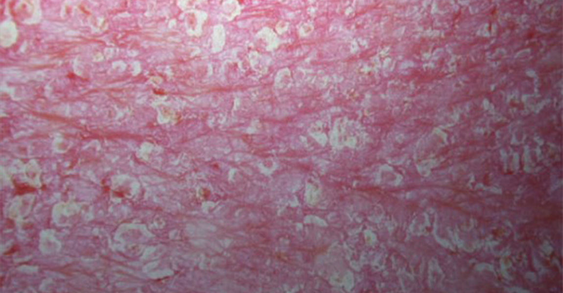 Erytroderminen psoriaasi