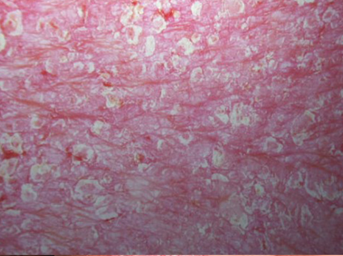 Erytroderminen psoriaasi