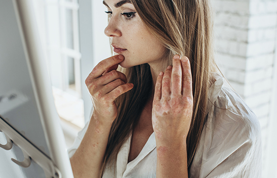 Psoriaatikon ihon ehostaminen ja meikkaaminen