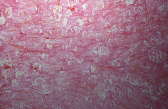 Erytroderminen psoriaasi