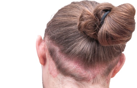 Scalp Psoriasis