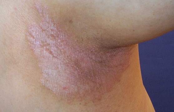 Inverse (flexural)  psoriasis