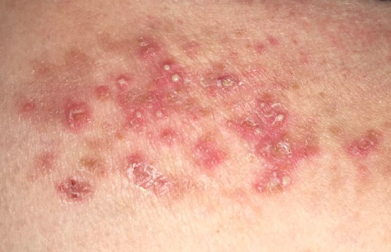 Pustular psoriasis