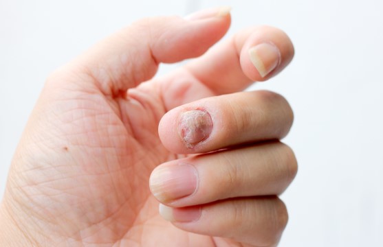 Nail Psoriasis