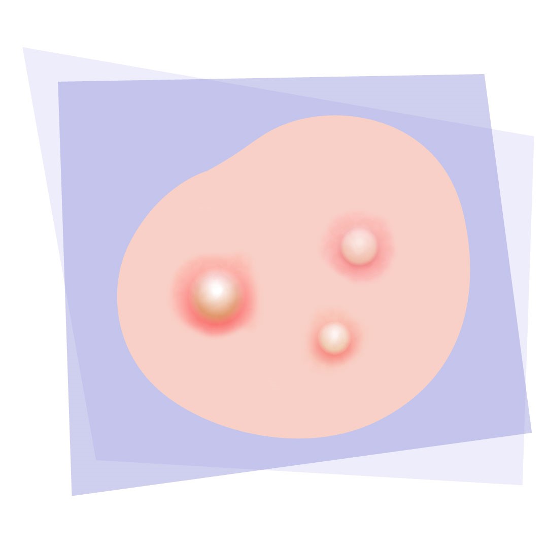 illustration nodules ou plaies qui suppurent