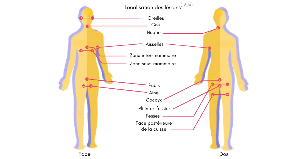 Schéma localisation lesions maladie de Verneuil