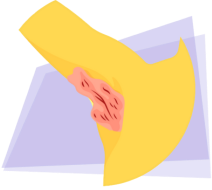 illustration lésions typiques