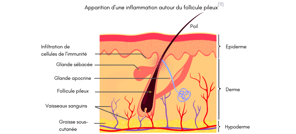 Schéma apparition d’une inflammation autour du follicule pileux 