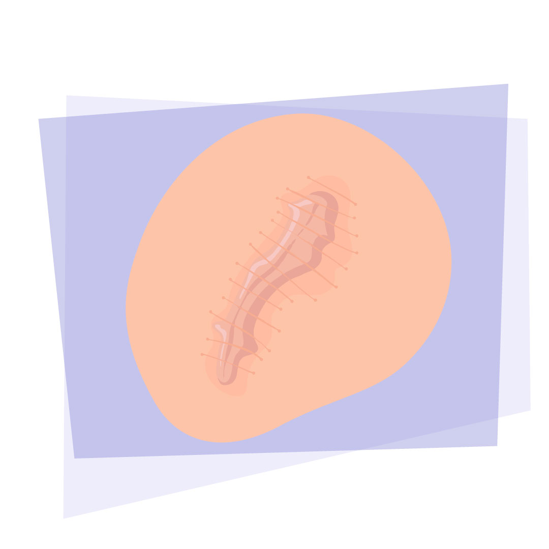 illustration cicatrice
