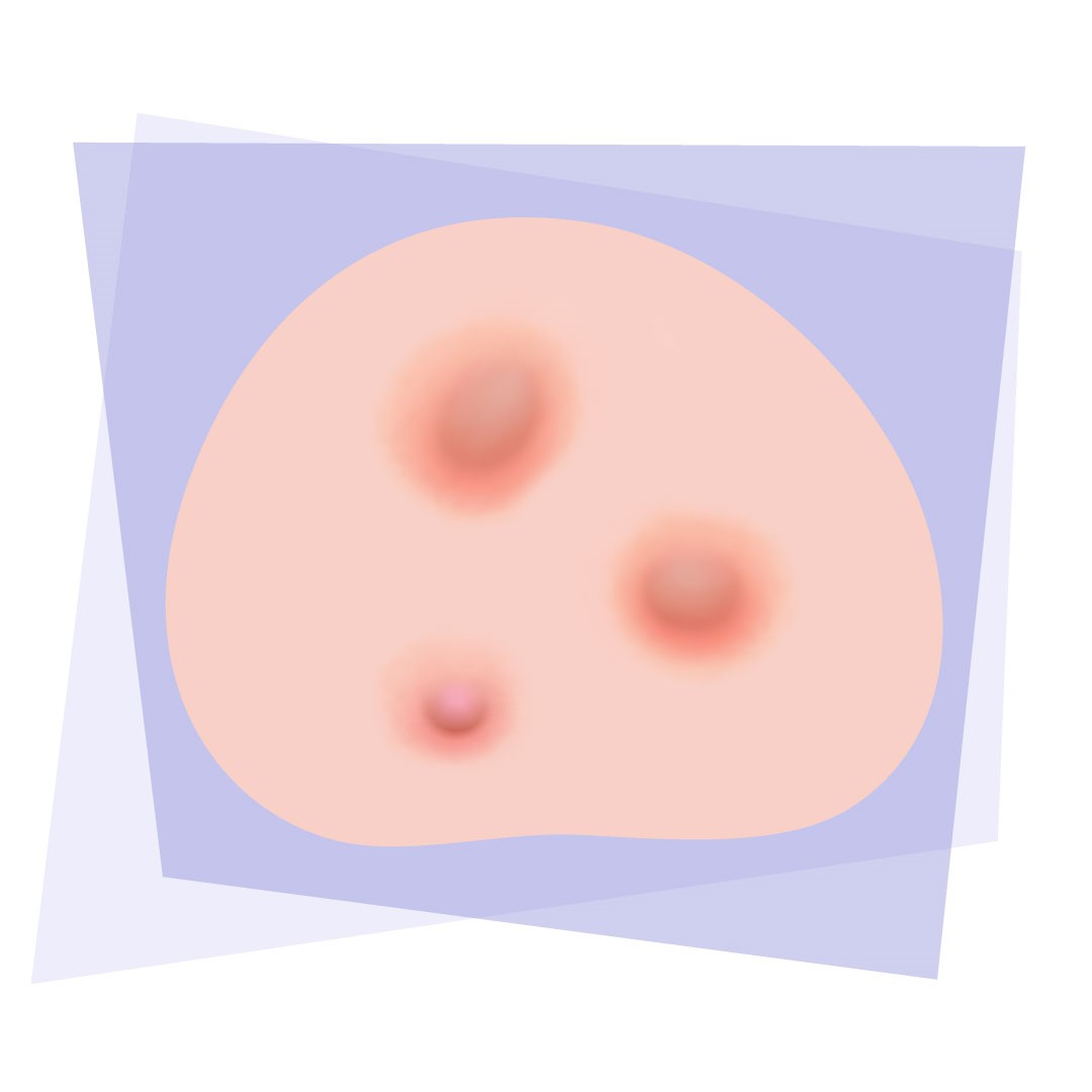 illustration nodules