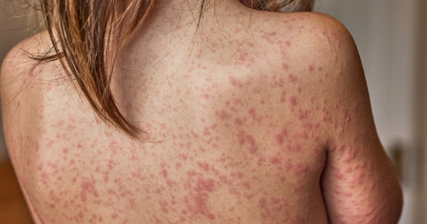 espalda chicas psoriasis