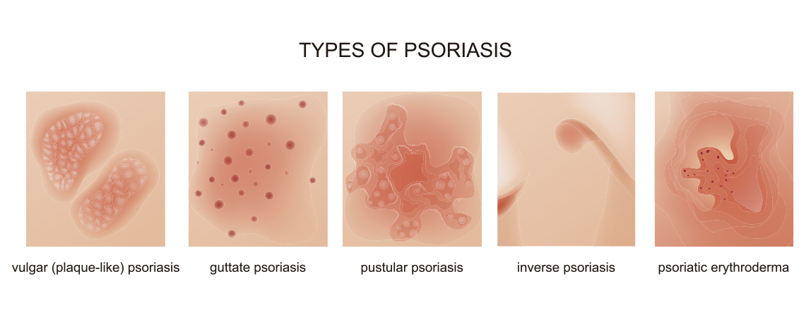 tipos de psoriasis