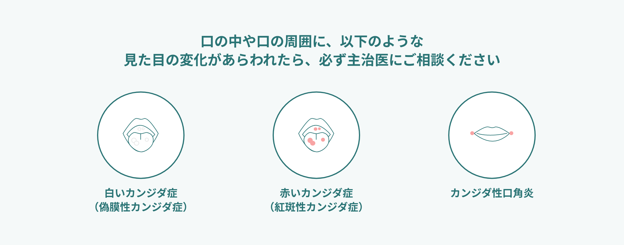 口の中や口の周囲に、以下のような見た目の変化があらわれたら、必ず主治医にご相談ください　白いカンジダ症（偽膜性カンジダ症）　赤いカンジダ症（紅斑性カンジダ症）　カンジダ性口角炎