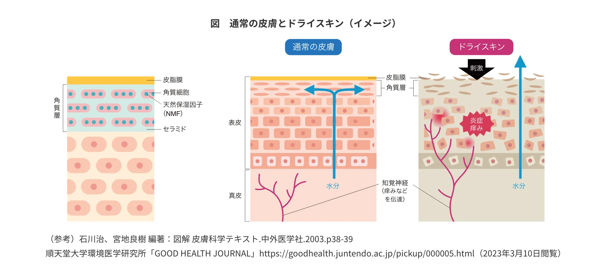 図 通常の皮膚とドライスキン（イメージ）