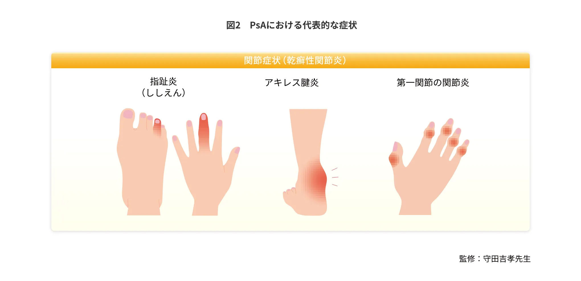 図2 PsAにおける代表的な症状