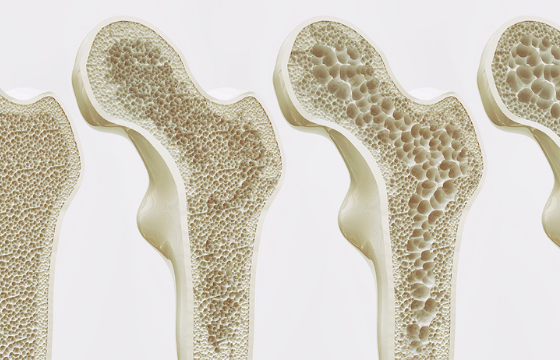 osteoporosis-teaser