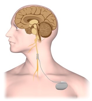 epilepsie-vagusnerv-stimulation