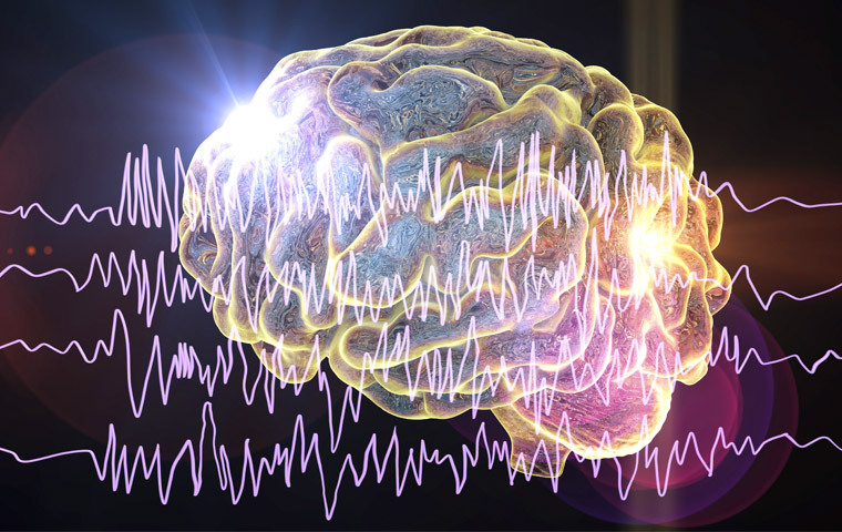 cerebro epilepsia refractaria